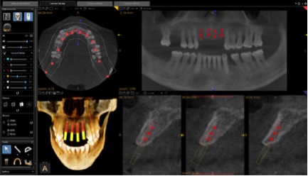 Implantes y cirugía dental