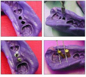 Implantes y cirugía dental