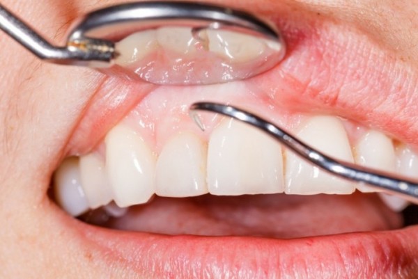 Limpieza dental