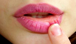 Aftas o úlceras: 7 respuestas y recomendaciones de tu dentista