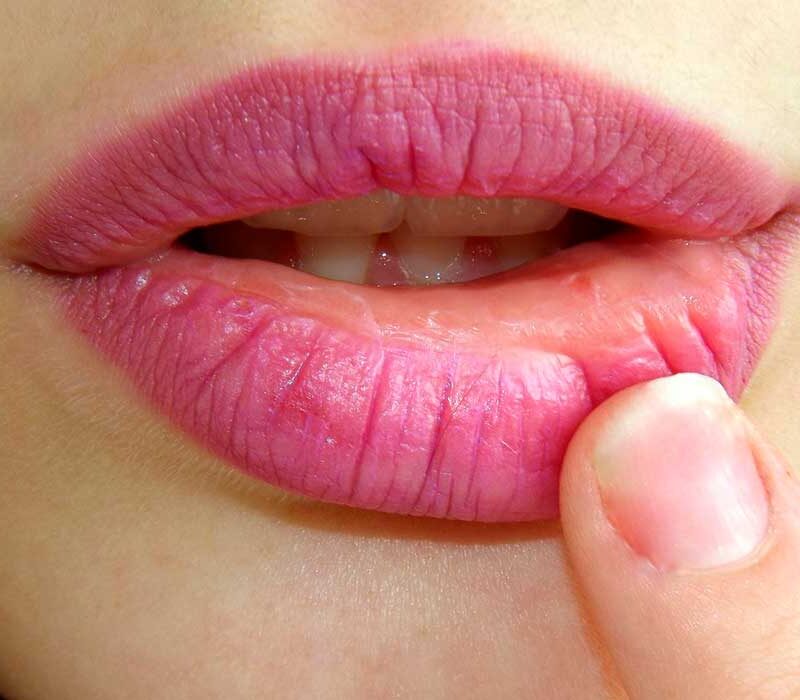 Aftas o úlceras: 7 respuestas y recomendaciones de tu dentista