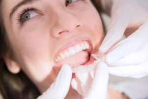 5 motivos para ponerse ortodoncia