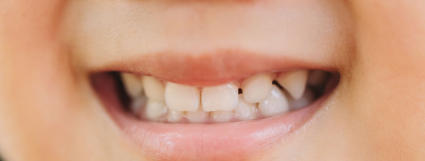 6 motivos para cuidar los dientes de leche