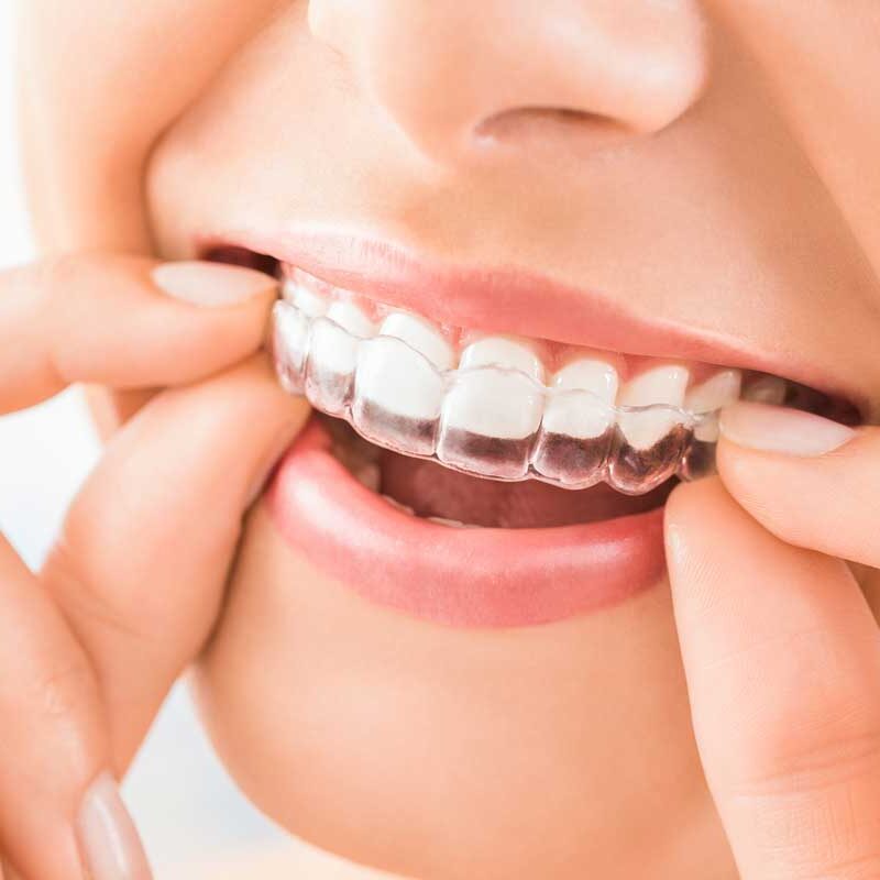 Beneficios de realizar un tratamiento de ortodoncia