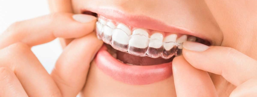 Beneficios de realizar un tratamiento de ortodoncia