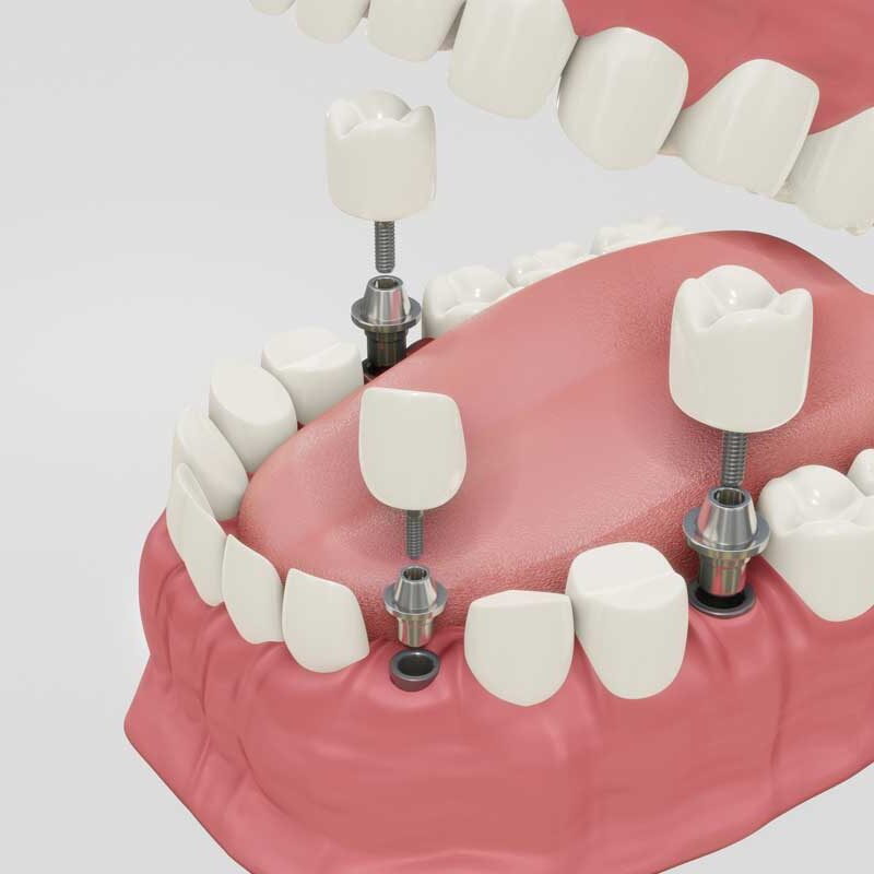 ¿Miedo a los implantes?