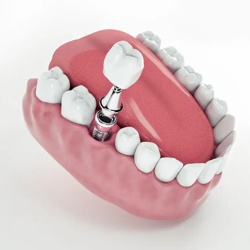 10 preguntas frecuentes sobre implantes